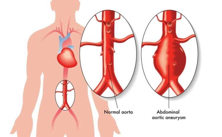  Abdominal Aort Anevrizması
